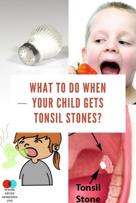 How Do I Remove Tonsil Stones? Easy Solutions