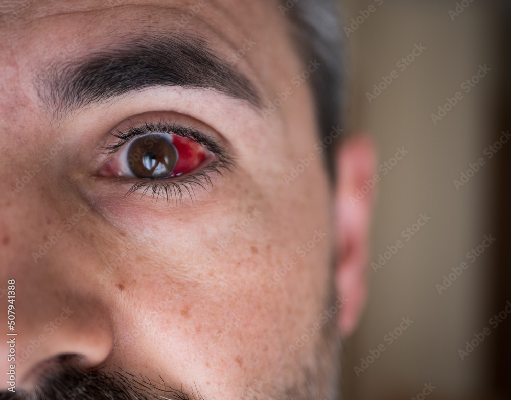 How To Heal Broken Blood Vessel In Eye Fast