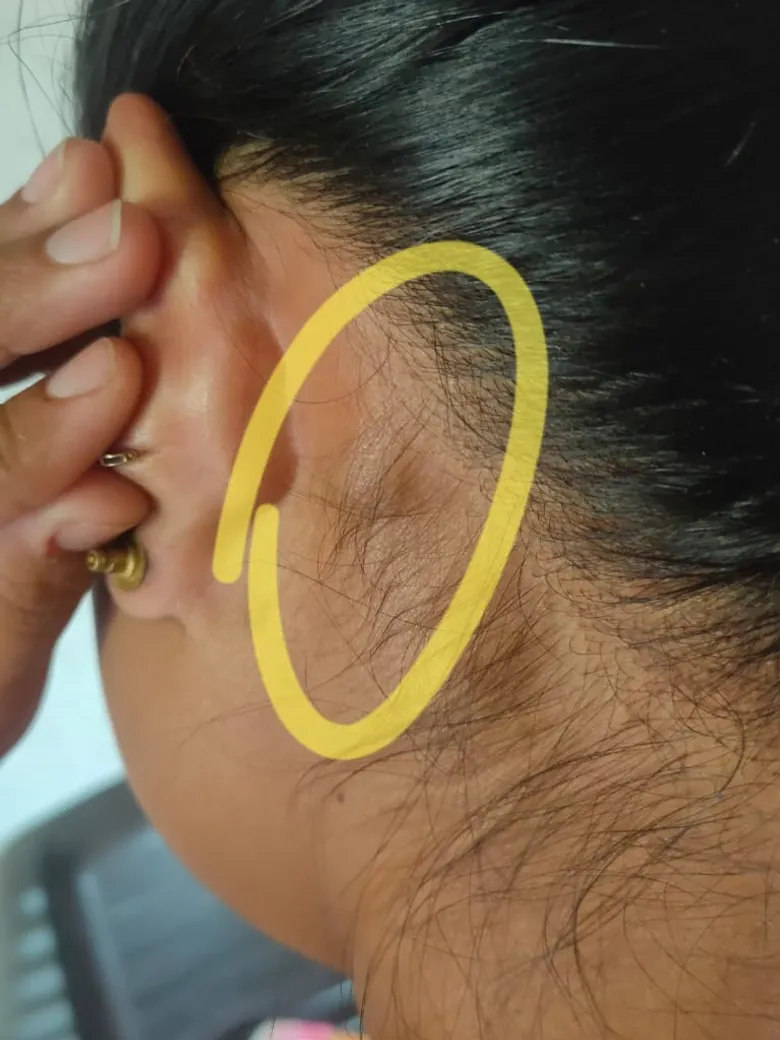 Lump Behind Ear Treatment Guide