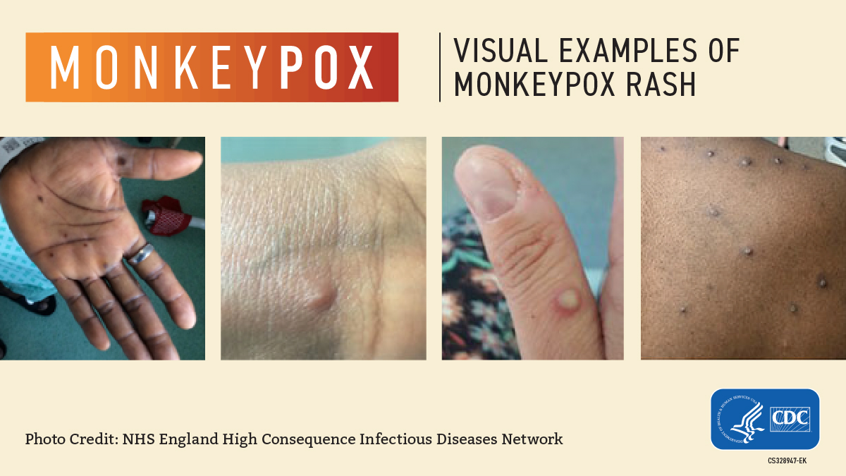 Monkeypox And Children What To Know About Testing Symptoms