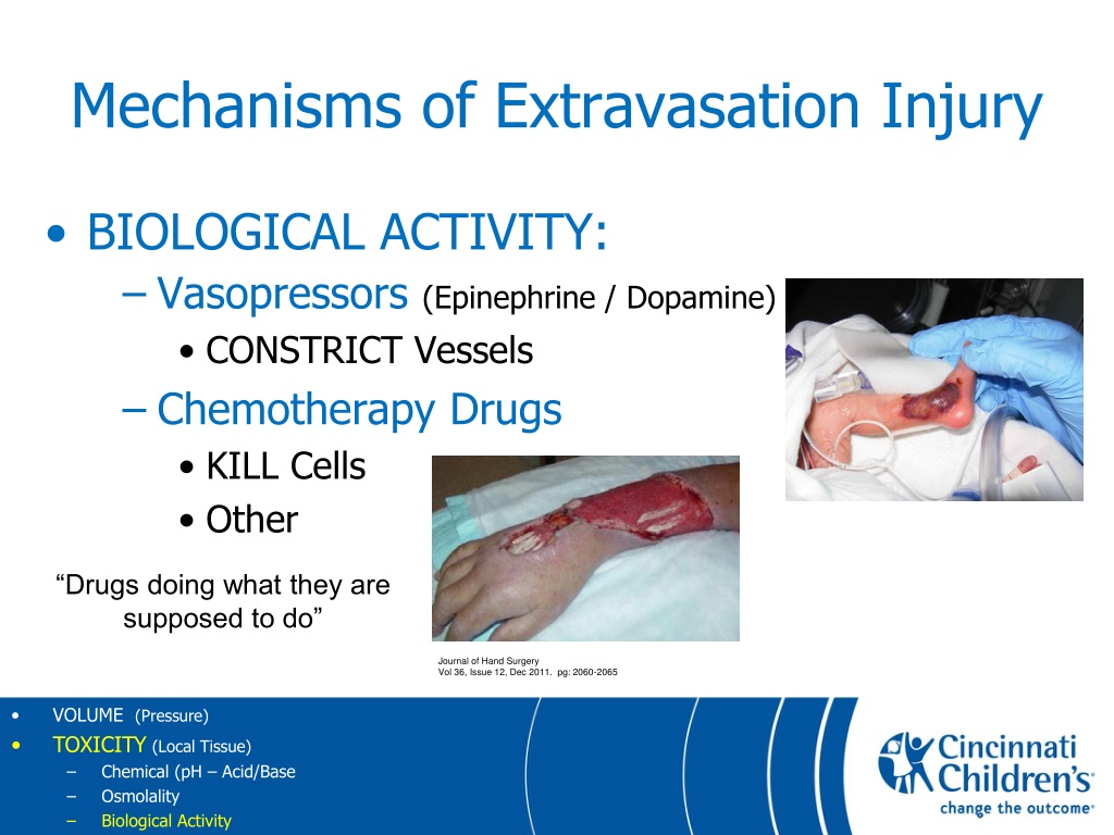 Ppt Preventing Pediatric Intravenous Extravasation Injuries Powerpoint Presentation Id 9611207