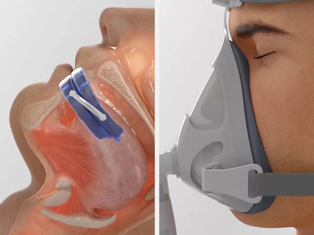 Sleep Apnea Devices And Night Guards Synergy