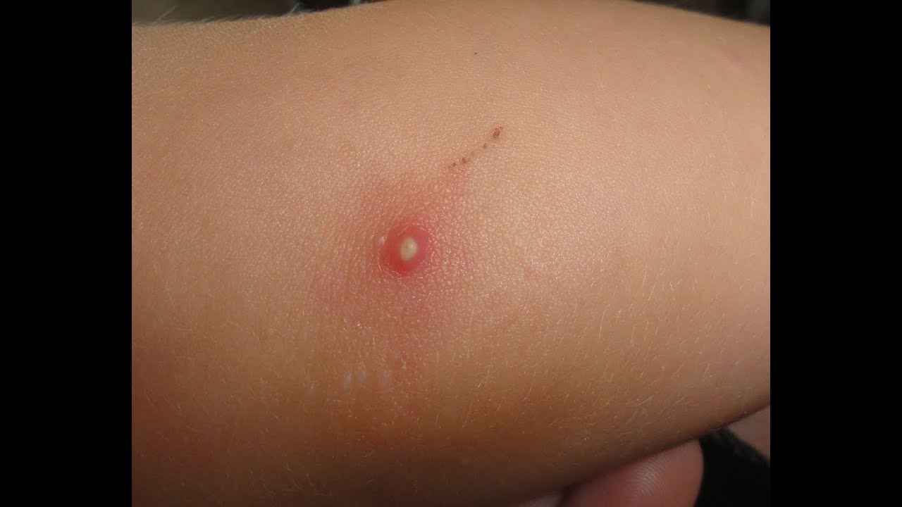 When Is Viral Rash Contagious? Stay Safe